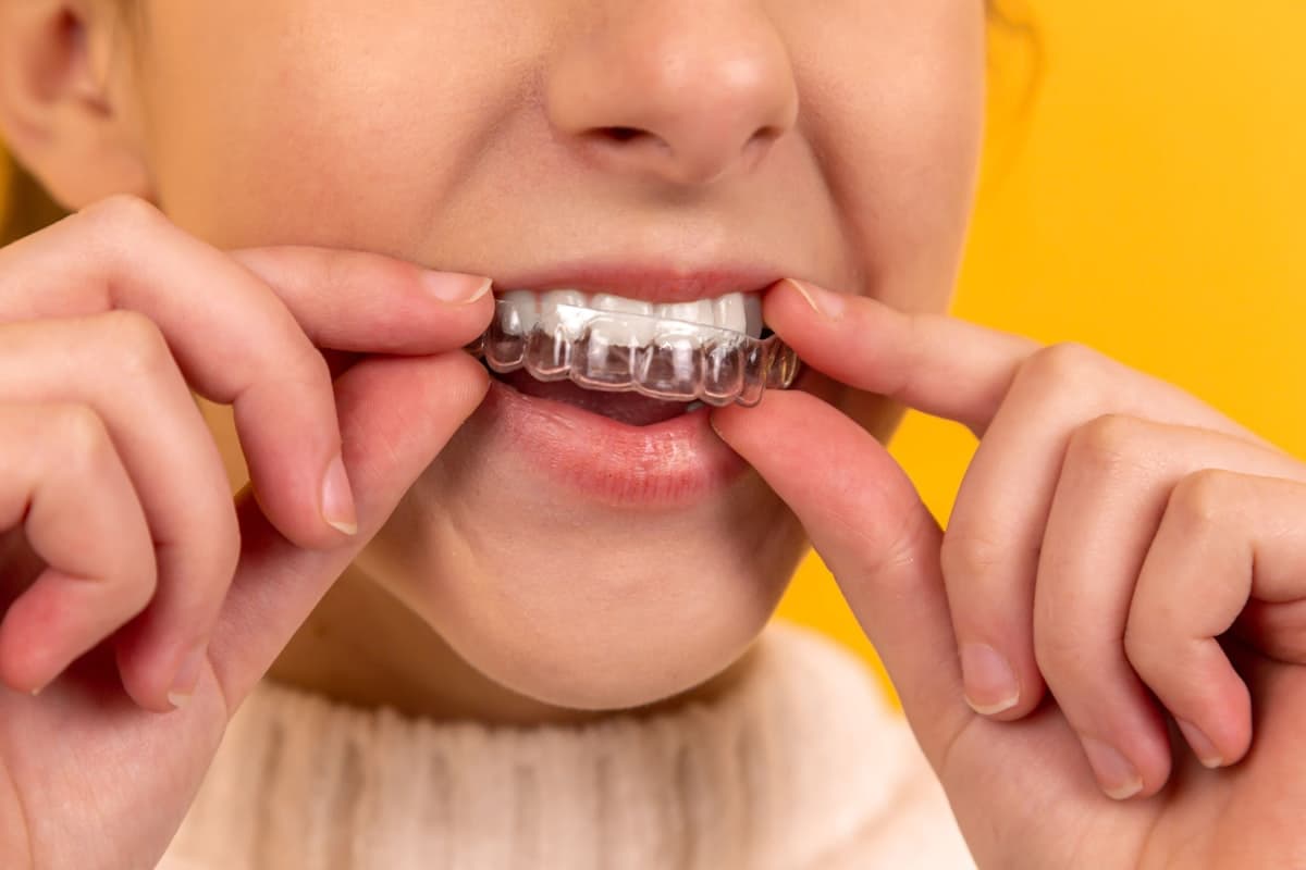 Ortodoncia con brackets y alineadores invisibles Invisalign en Caballito