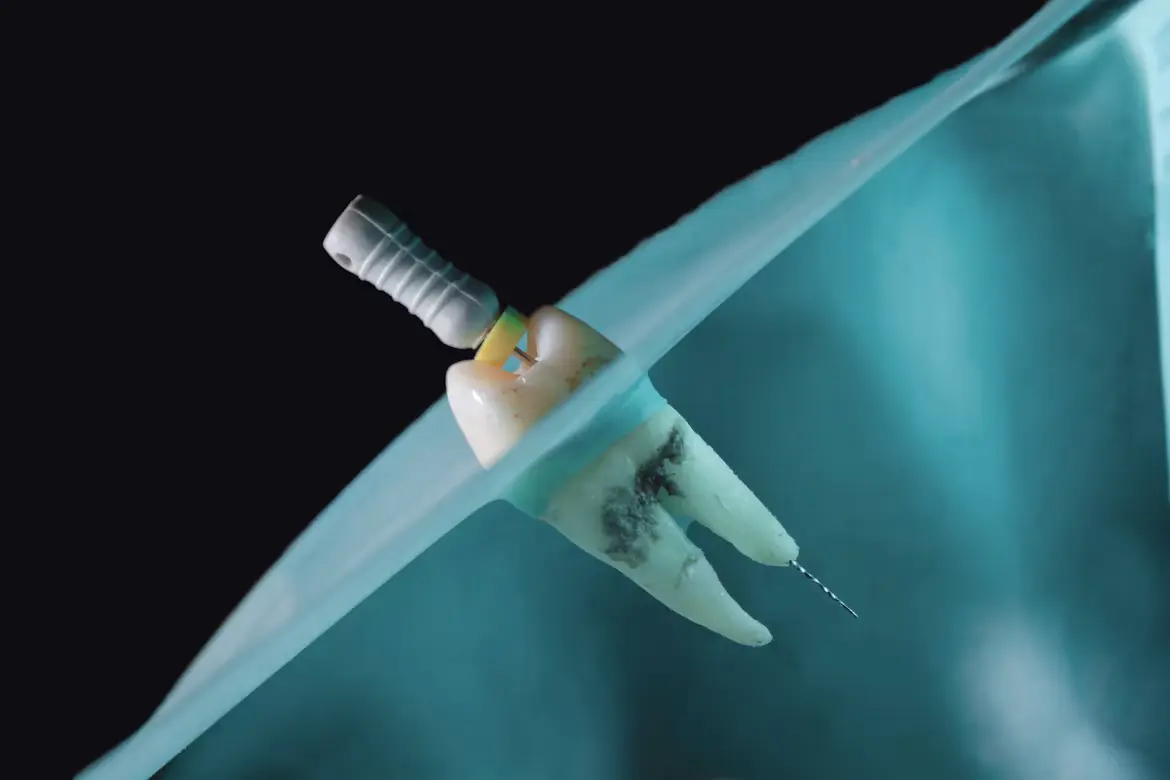 Endodoncia y tratamiento de conducto en Caballito, CABA